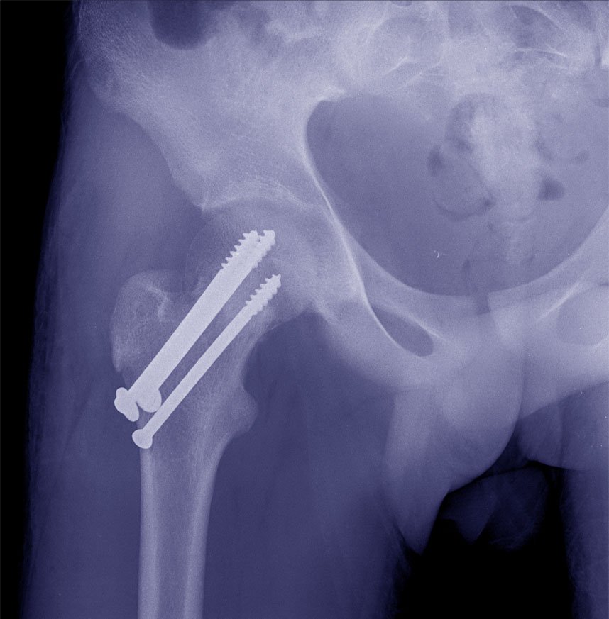 Операция тазобедренный кость. Перелом шейки бедра остеосинтез рентген. Трохантерит тазобедренного сустава рентген. Металлостеосинтез тазобедренного сустава.
