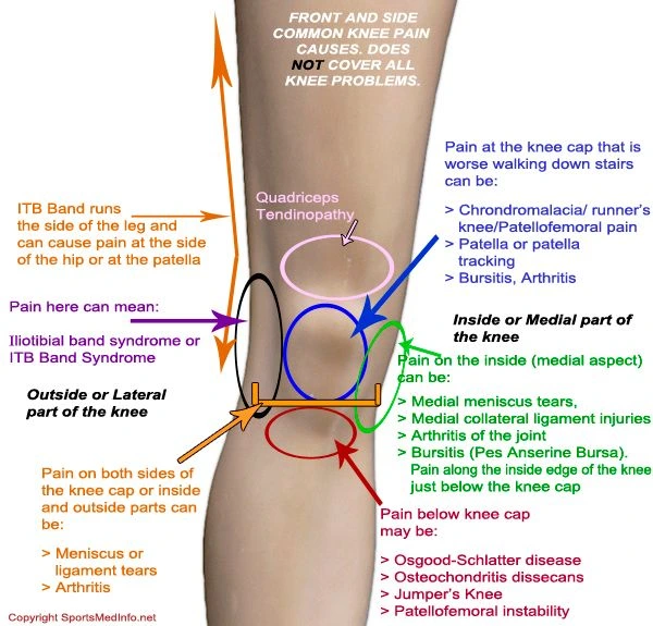 How to Fix Lateral Knee Pain for Climbers (Outer Knee Pain, LCL