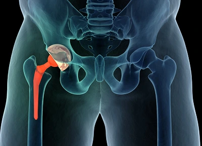 How to Sleep After Total Hip Replacement Surgery