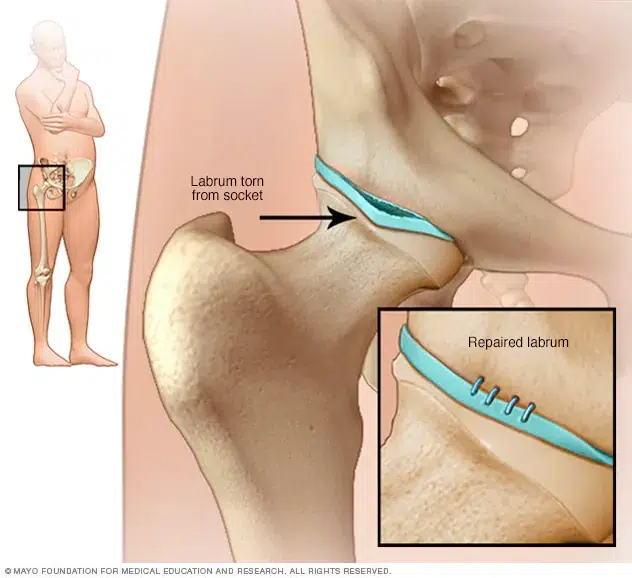 Hip Flexor Strain – an overview of what you need to know